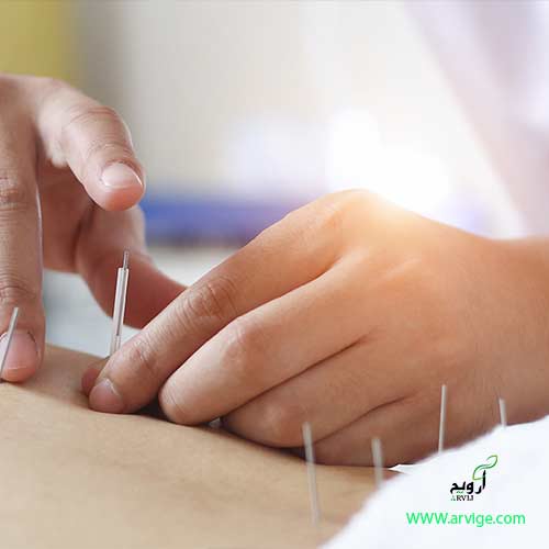 طب سوزنی آرویج